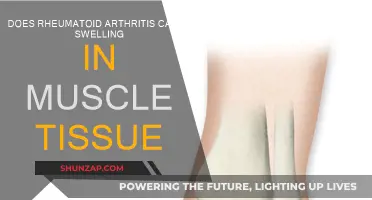 Rheumatoid Arthritis: Muscle Swelling and Inflammation