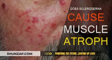 Scleroderma's Impact: Muscle Atrophy Explained