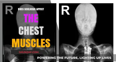 Exploring Scoliosis: Impact on Chest Muscles and Breathing