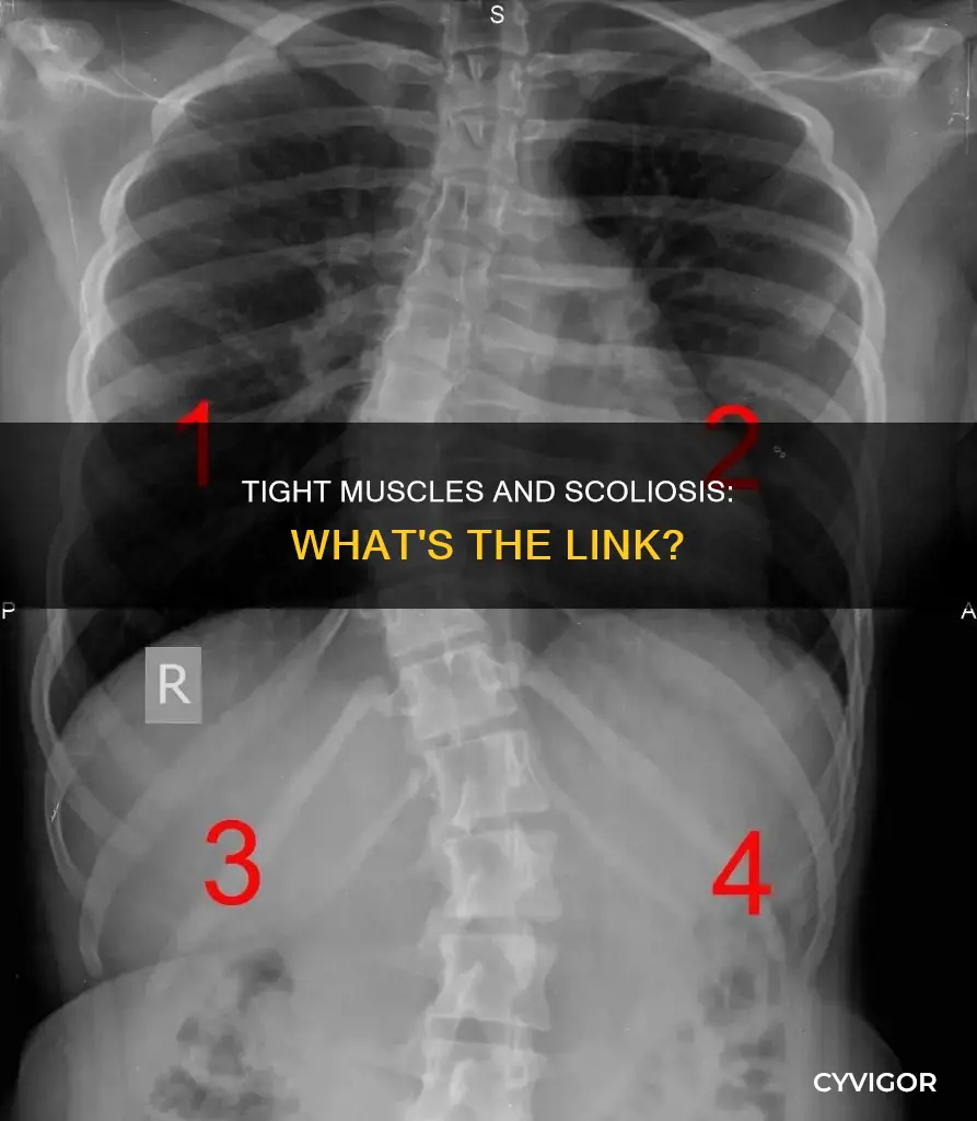 does scoliosis cause tight muscles