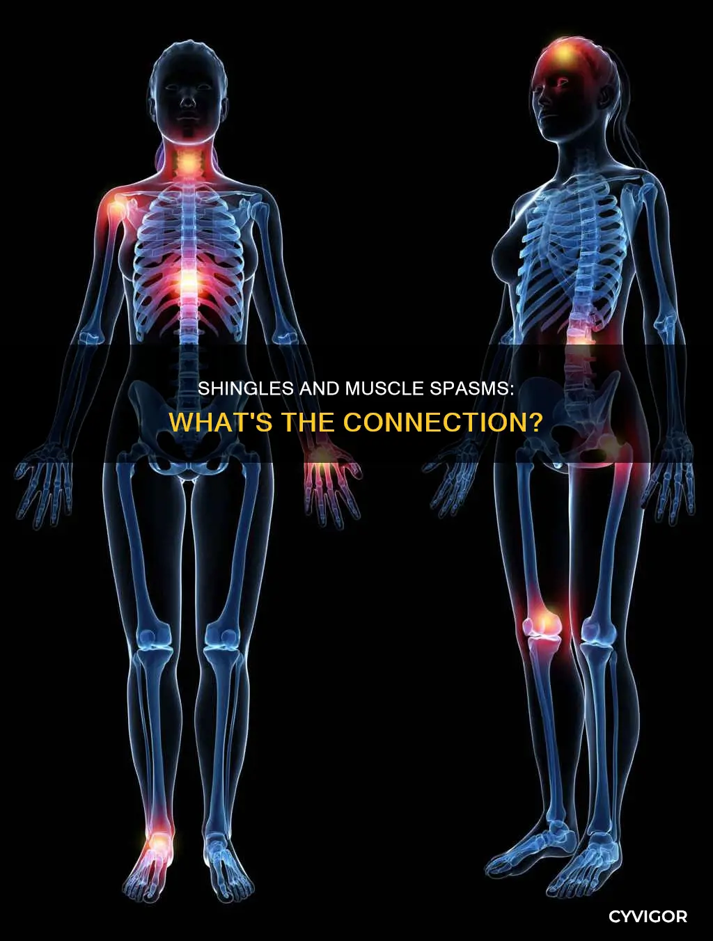 does shingles cause muscle spasms