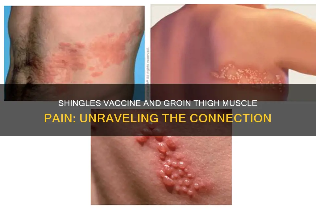 does shingles inoculation trigger pain in groin thigh muscles