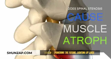 Spinal Stenosis and Muscle Atrophy: Is There a Link?