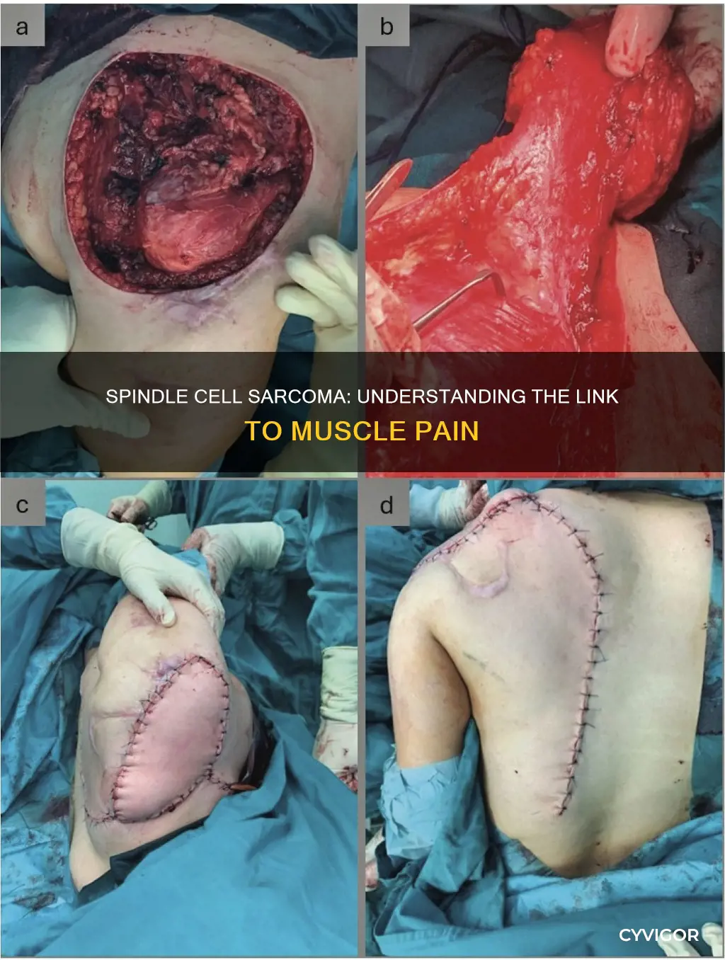 does spindel cell sarcoma cause muscle paon