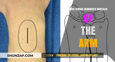 Stroke's Impact: Does It Cause Arm Muscle Denervation?