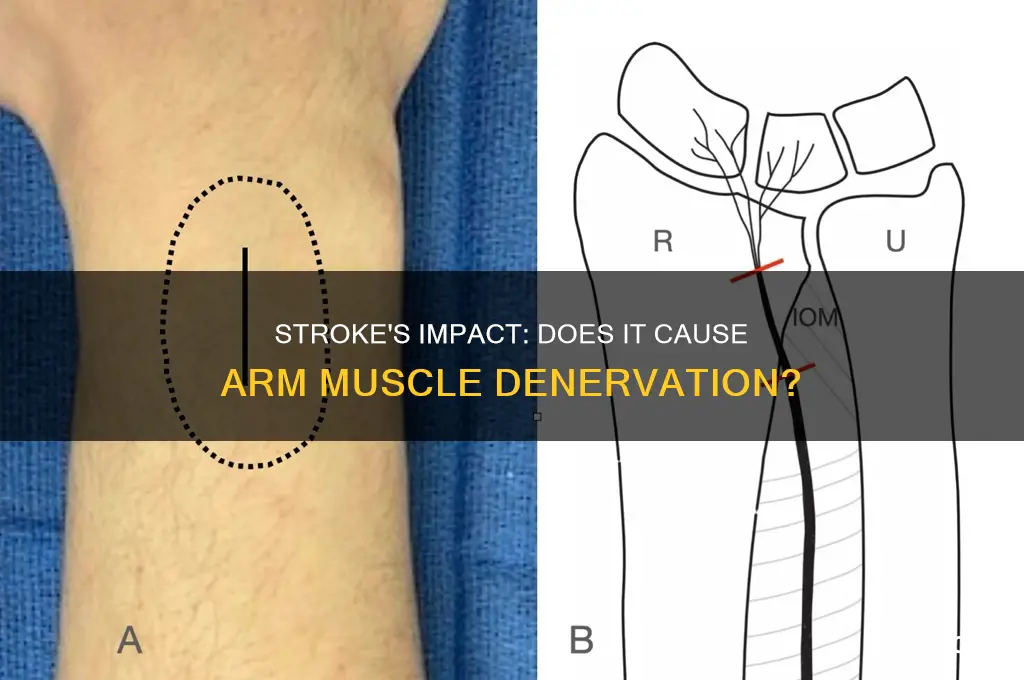 does stroke denervate muscles of the arm