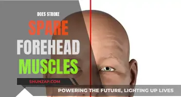 Stroke's Impact: Forehead Muscles and Their Fate