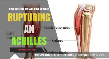 Unraveling the Myth: Calf Muscle and Achilles Rupture Connection