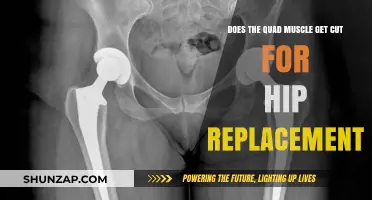 Understanding Hip Replacement: The Impact on Your Quadriceps Muscle