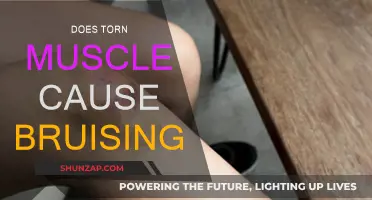 How Torn Muscles Cause Bruising and What to Do