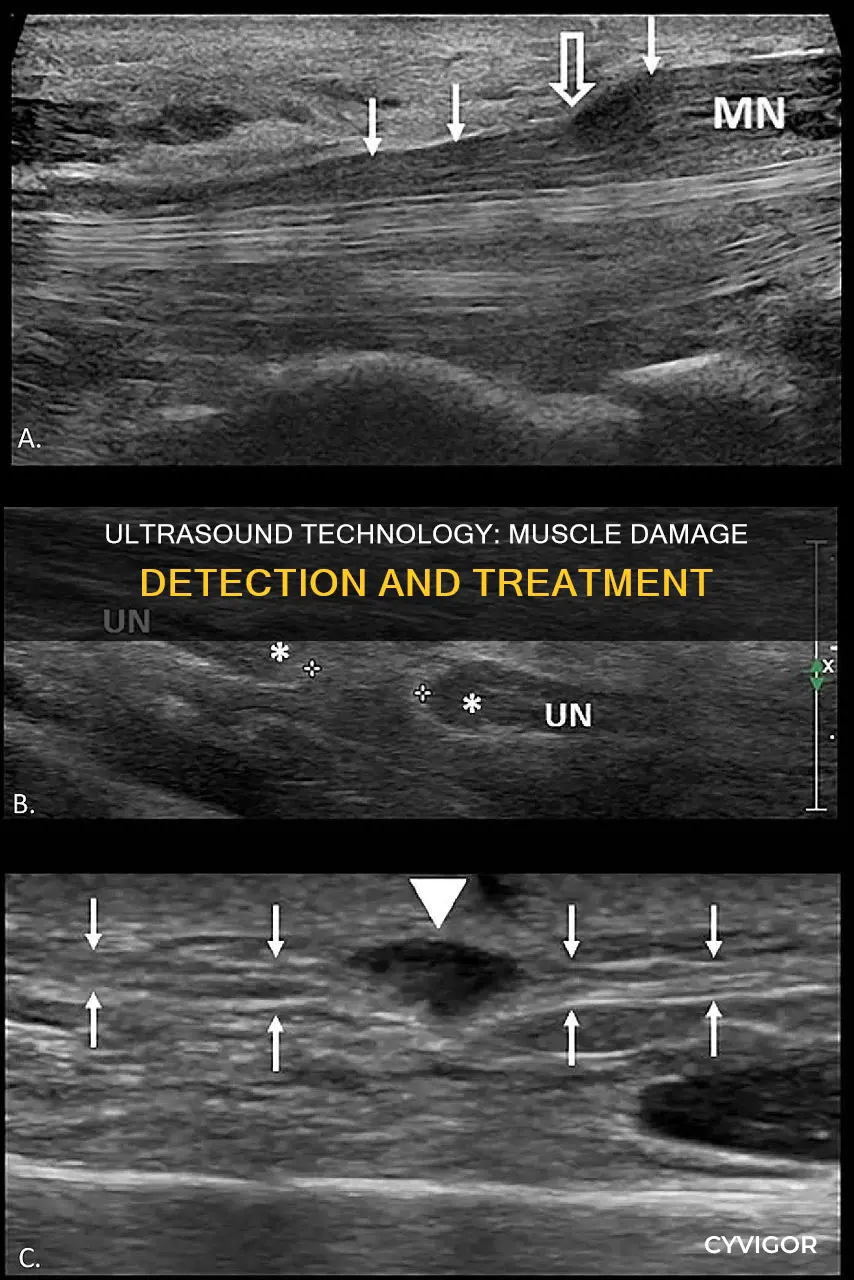 does ultrasound show muscle damage