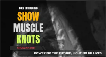 Ultrasound Technology: Detecting Muscle Knots and Their Treatment
