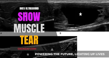 Ultrasound Imaging for Muscle Tears: What You Need to Know