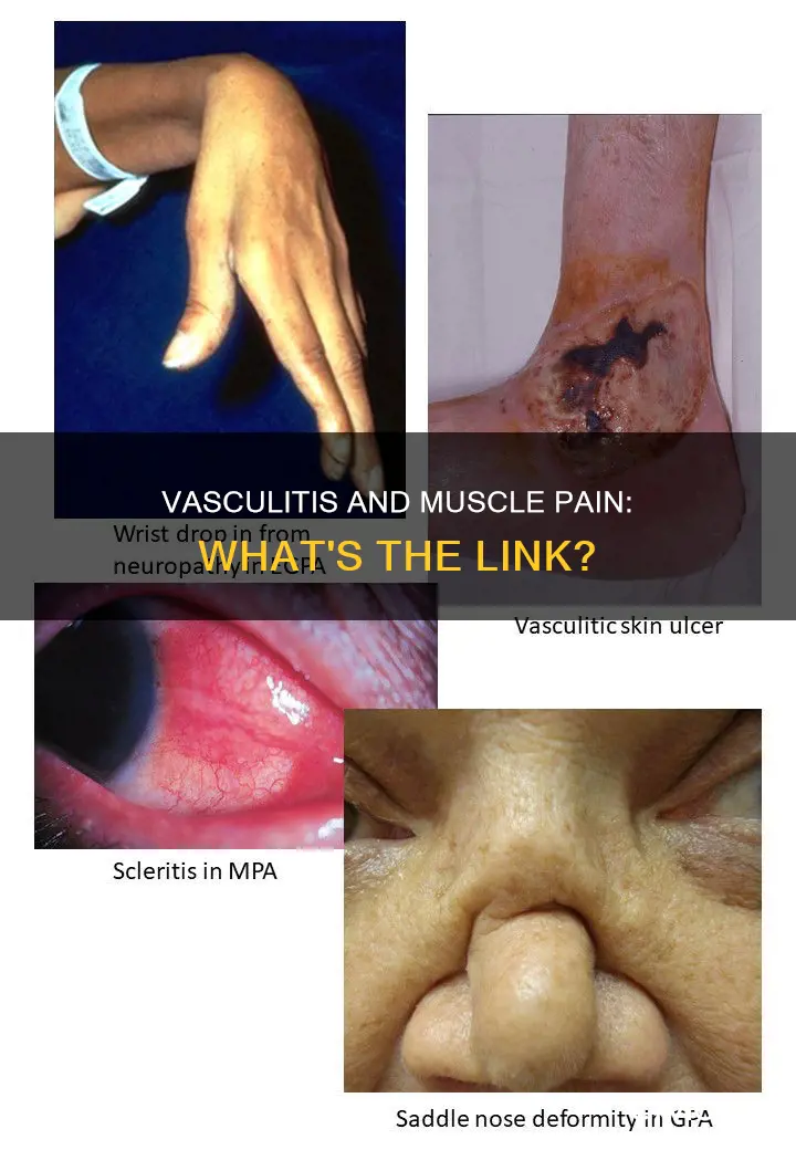 does vasculitis cause muscle pain