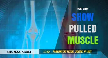 Can X-Rays Detect Pulled Muscles? Unraveling the Diagnostic Mystery