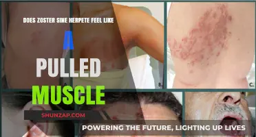 Zoster Sine Herpete vs. Pulled Muscle: Unraveling the Pain Mystery