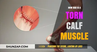 Understanding the Severity of a Torn Calf Muscle: A Comprehensive Guide