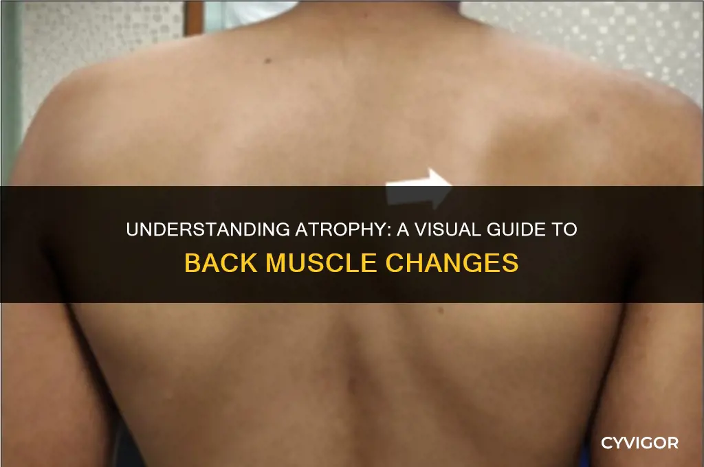 how do atrophy back muscles look like