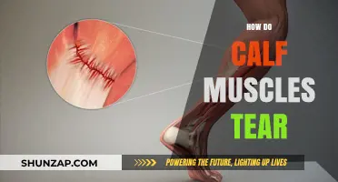 Understanding Calf Muscle Tears: Causes, Symptoms, and Recovery