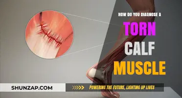 Diagnosing a Torn Calf Muscle: Symptoms, Causes, and Treatment Options