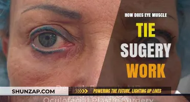 Understanding Eye Muscle Tie Surgery: Procedure, Benefits, and Recovery Explained
