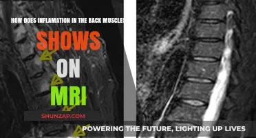 Unveiling Back Muscle Inflammation: An MRI Perspective