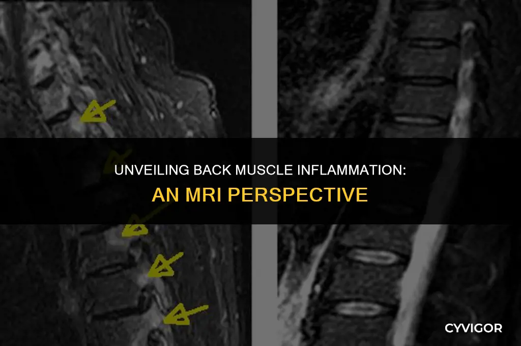 how does inflamation in the back muscles shows on mri