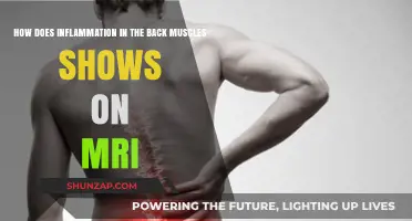 Unveiling Back Muscle Inflammation: An MRI Perspective