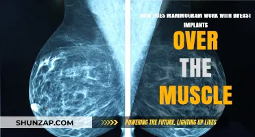 Mammograms and Breast Implants: Understanding Imaging Over the Muscle