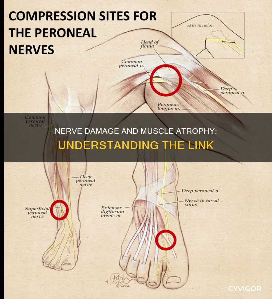 how does nerve damage cause muscle atrophy