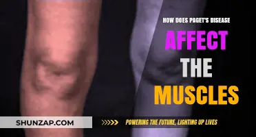 Understanding Paget's Disease: Its Impact on Muscle Health and Function