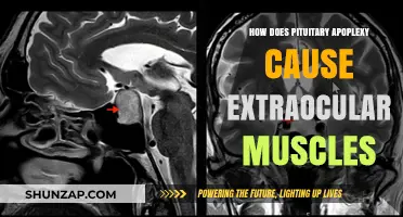 Pituitary Apoplexy: The Link to Extraocular Muscle Dysfunction