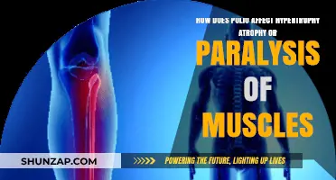 Understanding Polio's Impact: Muscle Hypertrophy, Atrophy, and Paralysis Explained