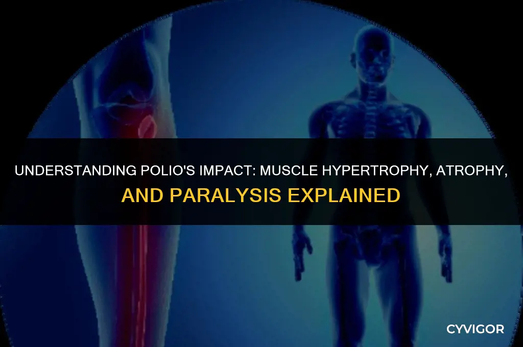 how does polio affect hypertrophy atrophy or paralysis of muscles