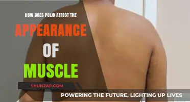 Understanding Polio's Impact: Muscle Appearance and Function