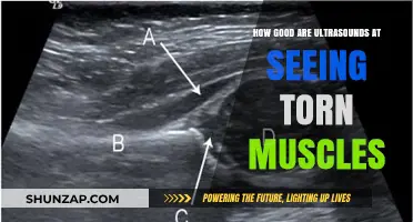 Ultrasound Accuracy in Detecting Torn Muscles: What You Need to Know