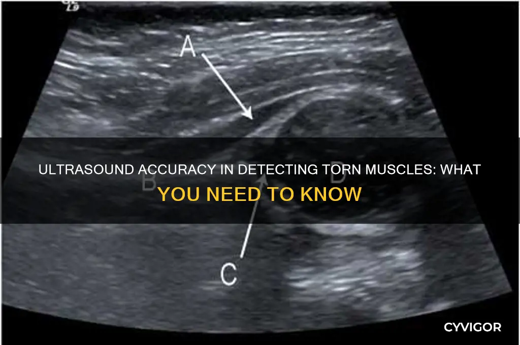how good are ultrasounds at seeing torn muscles