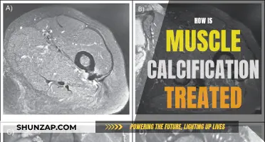 Muscle Calcification: Treatment Options and Management