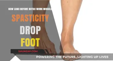 Botox for Drop Foot: Timeline for Muscle Spasticity Relief Explained