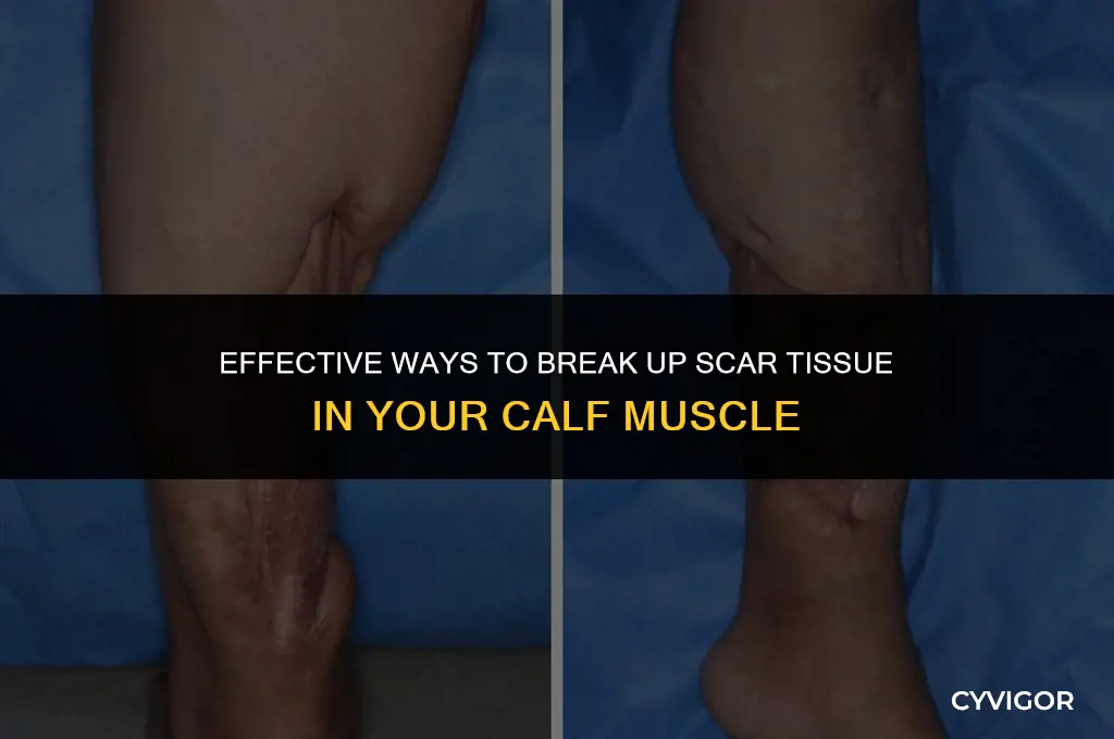 how to break up scar tissue in calf muscle