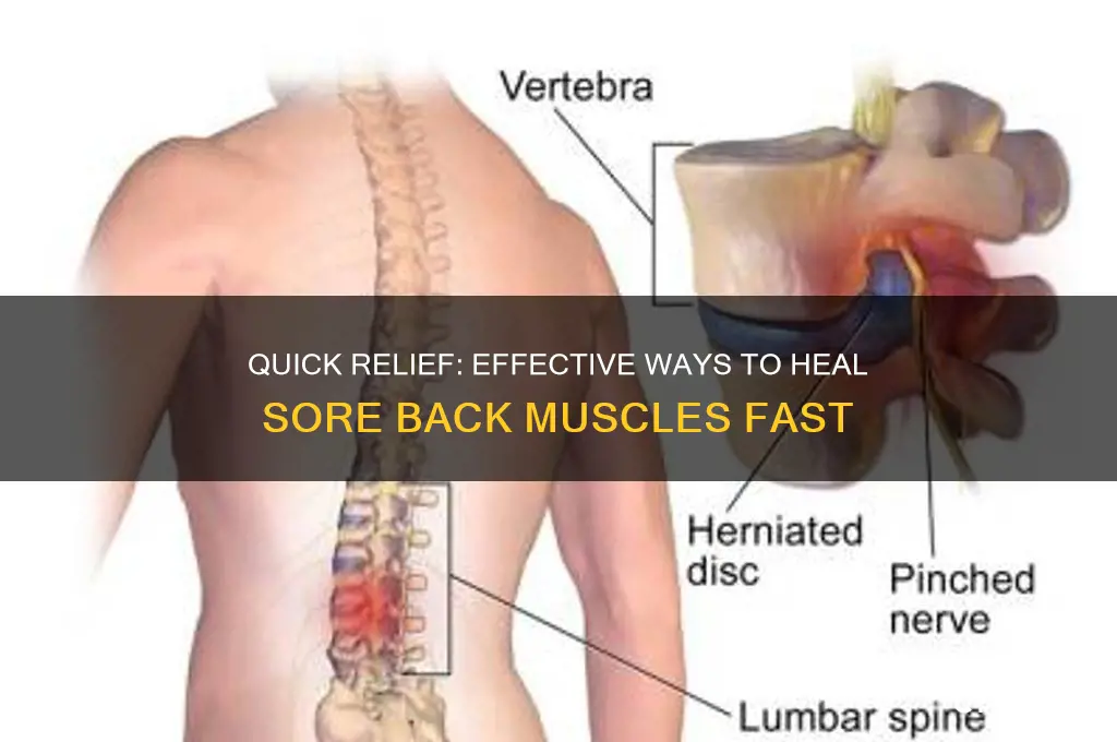 how to heal sore back muscles fast