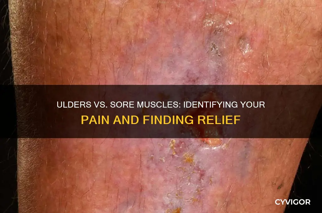 how to tell if i have ulders or sore muscles