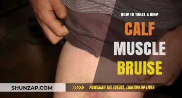 Effective Remedies for Treating a Deep Calf Muscle Bruise