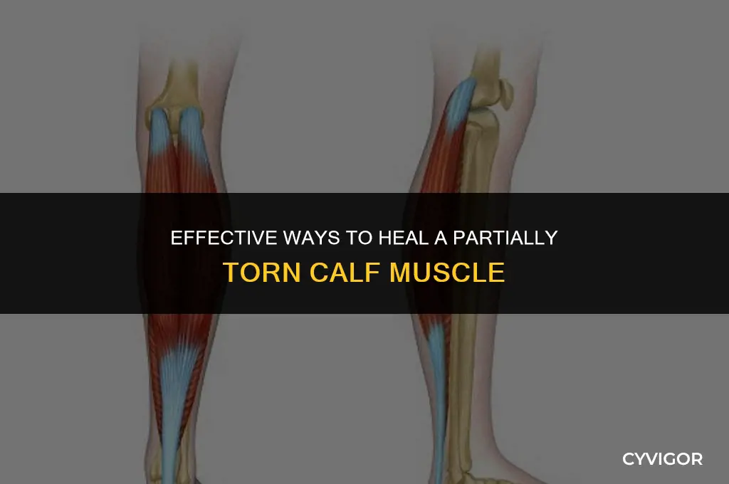 how to treat a partially torn calf muscle