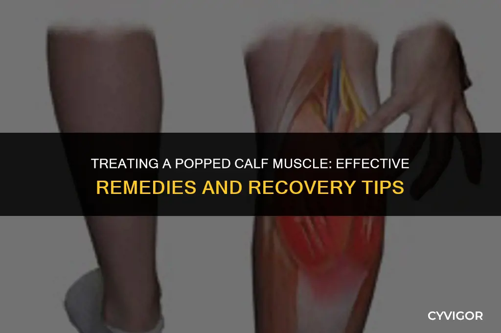how to treat a popped calf muscle