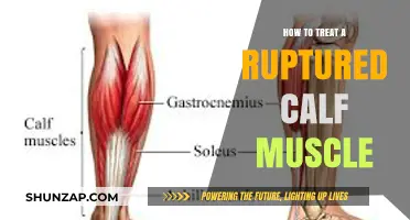Treating a Ruptured Calf Muscle: A Comprehensive Guide to Recovery
