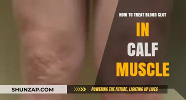 Effective Ways to Treat a Blood Clot in Your Calf Muscle