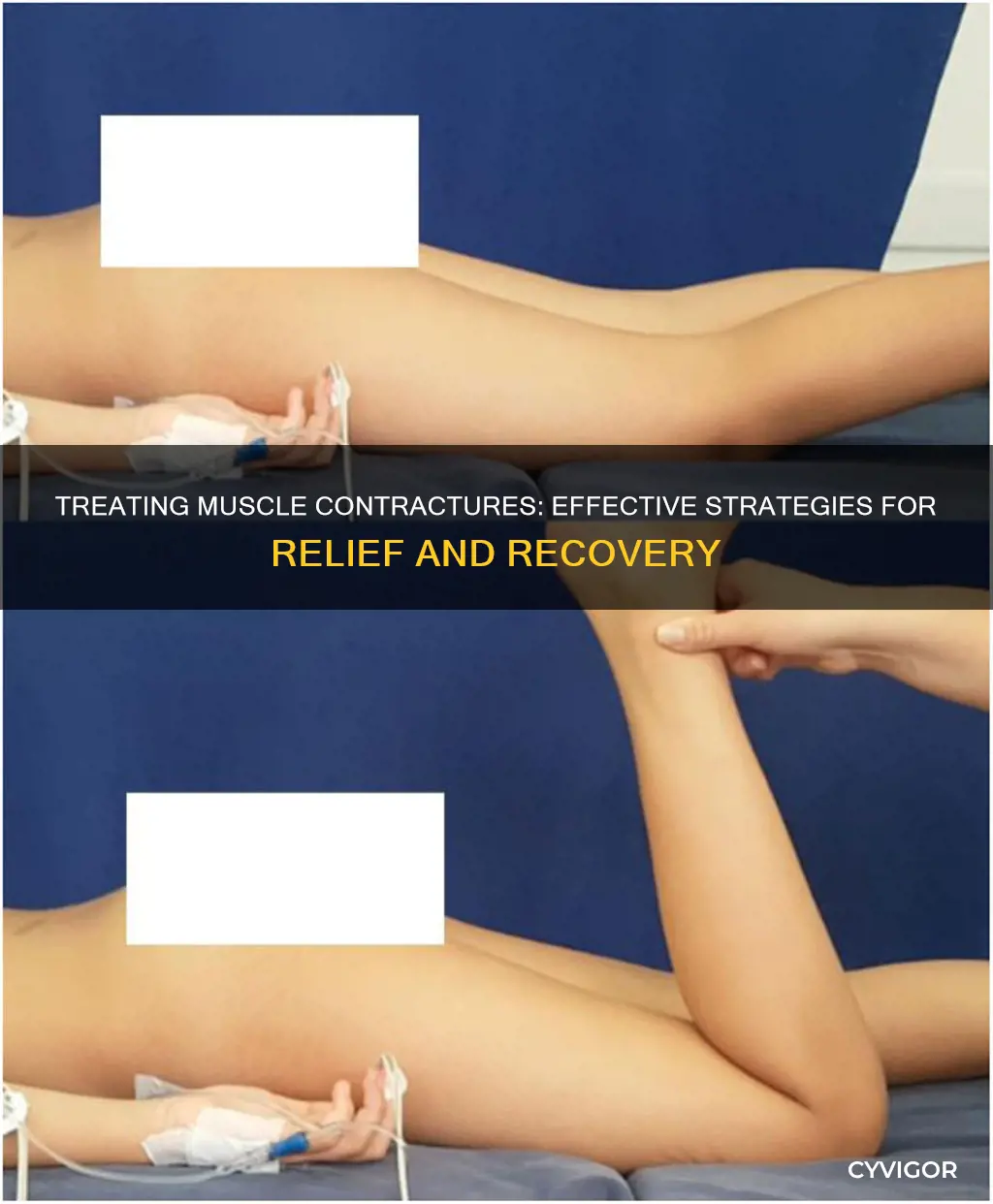 how to treat muscle contractures