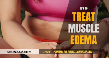 Treating Muscle Edema: Effective Strategies for Quick Recovery