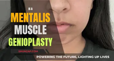 Muscle Genioplasty: The Mentalis Makeover